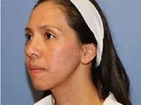 Laser Skin Resurfacing Before & After