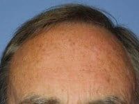 Laser Skin Resurfacing Before & After