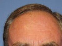 Laser Skin Resurfacing Before & After