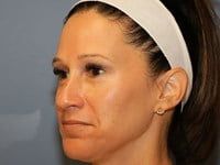 Laser Skin Resurfacing Before & After