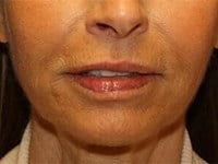 Laser Skin Resurfacing Before & After