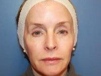 Laser Skin Resurfacing Before & After