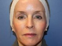 Laser Skin Resurfacing Before & After