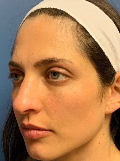 Laser Skin Resurfacing Before & After