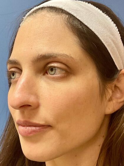 Laser Skin Resurfacing Before & After