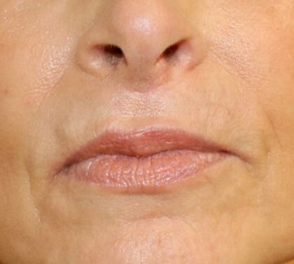 Laser Skin Resurfacing Before & After