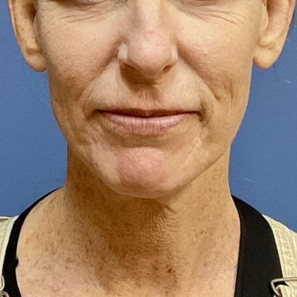 Laser Skin Resurfacing Before & After