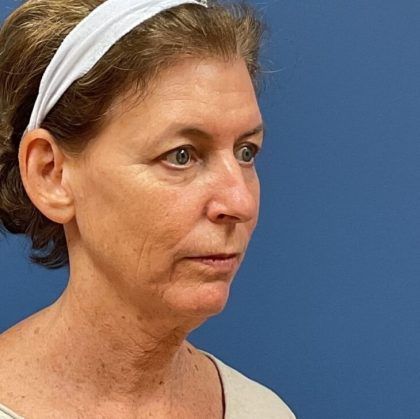 Laser Skin Resurfacing Before & After