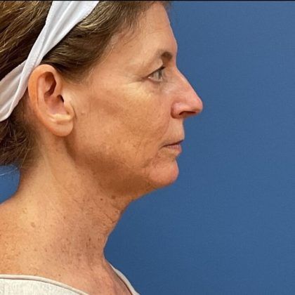 Laser Skin Resurfacing Before & After