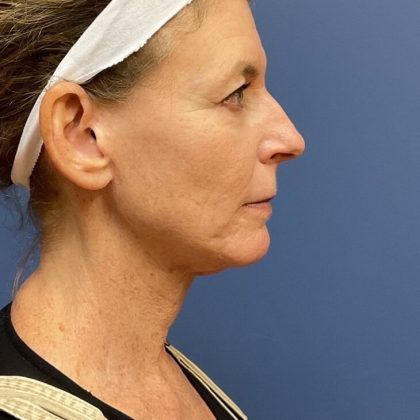 Laser Skin Resurfacing Before & After