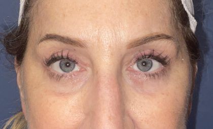 Laser Skin Resurfacing Before & After