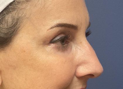 Laser Skin Resurfacing Before & After