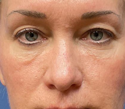 Laser Skin Resurfacing Before & After