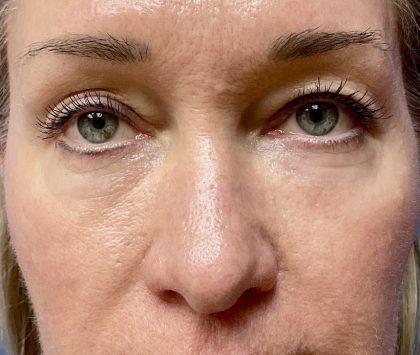 Laser Skin Resurfacing Before & After