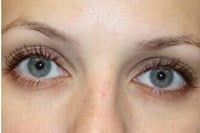 Latisse Before & After