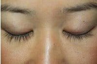 Latisse Before & After